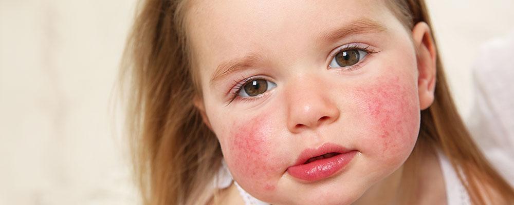 Chicago food allergy lawsuit attorney